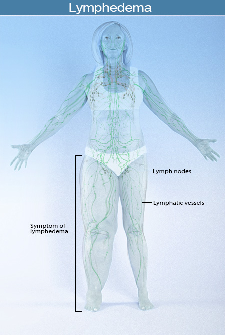 2015-illustration-lymphedema