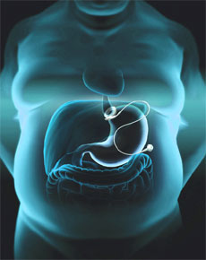 Pros & Cons of Bariatric Surgery