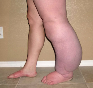 Learning About Lymphedema