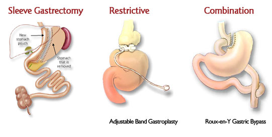 surgery_types