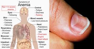 Anemia