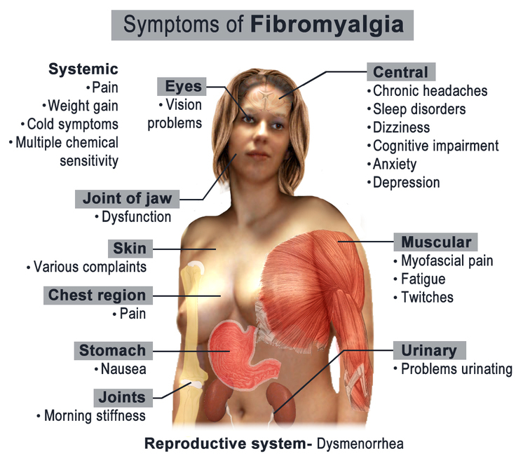 Миалгия что это лечение у женщин. Фибромиалгия. Фибромиалгия 18 точек. Фибромиалгический болевой синдром. Фибро алгия.
