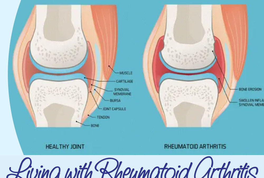 Living With Rheumatoid Arthritis